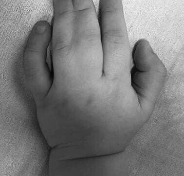 Ребенку разделили срощенные пальцы на обеих кистях в Московской области | Новости Московской области | Новости Подмосковья 
