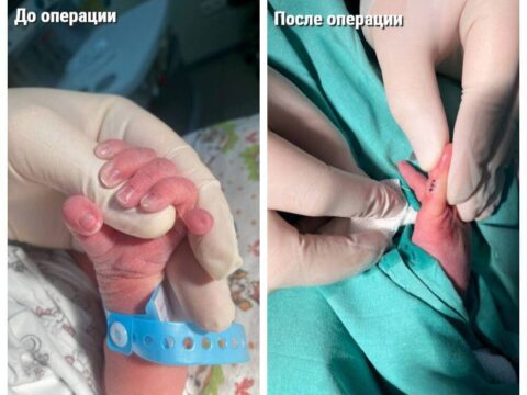 Подмосковные хирурги прооперировали шестипалого младенца | Новости Московской области | Новости Подмосковья 