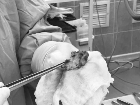 В Московской области нейрохирурги спасли мужчину с редкой опухолью спинного мозга | Новости Московской области | Новости Подмосковья 
