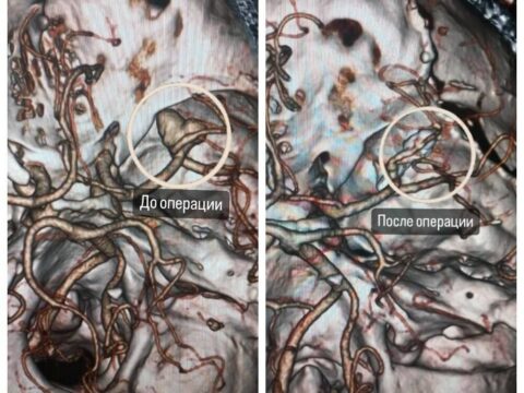 Подмосковные нейрохирурги удалили мужчине крупную мозговую аневризму в форме сердца | Новости Московской области | Новости Подмосковья 