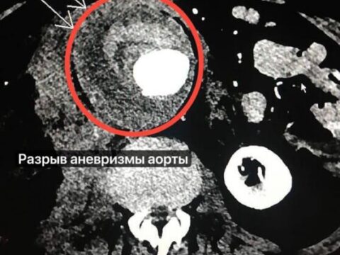 В Подмосковье врачи спасли мужчину с разрывом брюшной аорты | Новости Московской области | Новости Подмосковья 