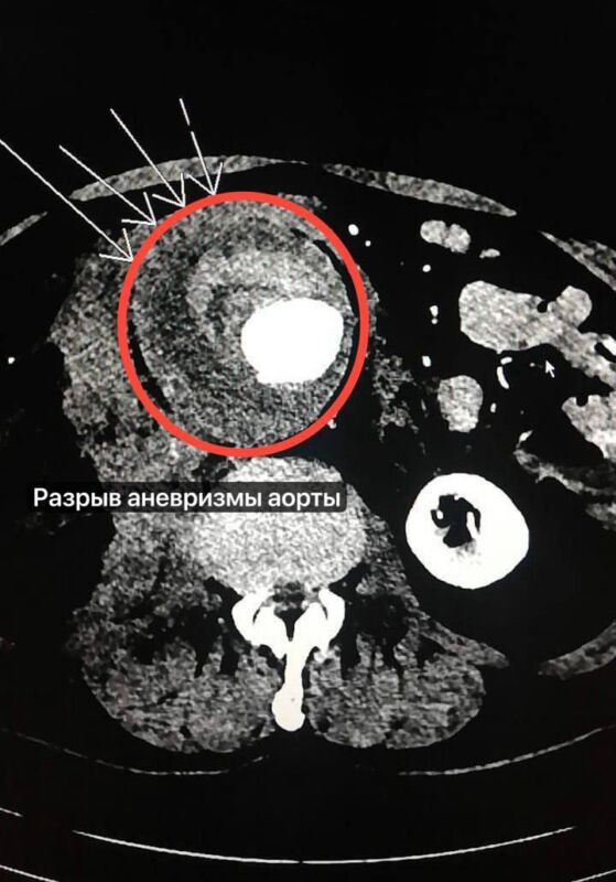 В Подмосковье врачи спасли мужчину с разрывом брюшной аорты | Новости Московской области | Новости Подмосковья 