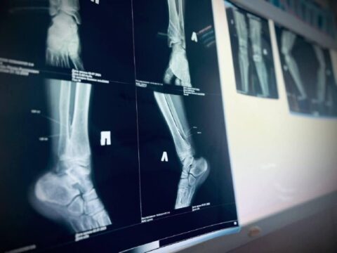 Подмосковные врачи спасли пациента от потери ноги из-за проблем с холестерином | Новости Московской области | Новости Подмосковья 